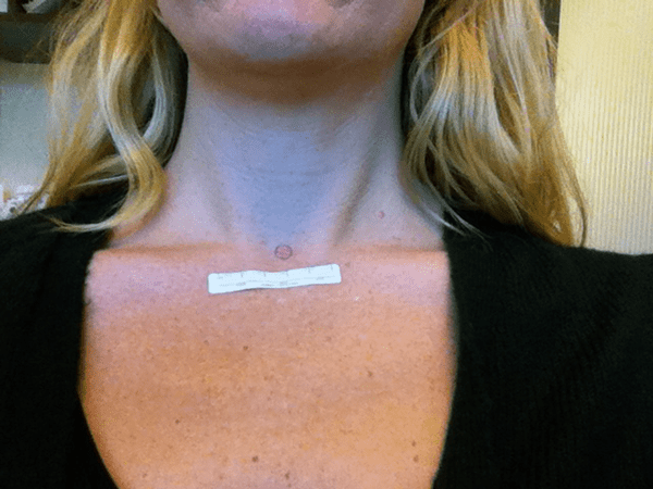 What my basal cell carcinoma on my neck looked like before Mohs surgery