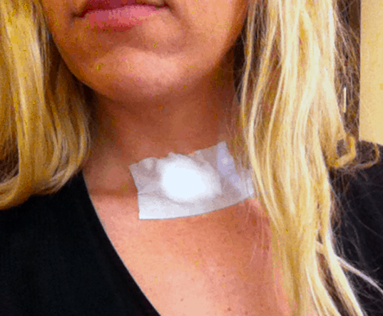 Close up of a cotton ball on a woman's neck stuck on with surgical tape.
