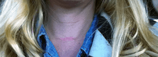 Close up of a scar on woman's neck from mohs procedure for skin cancer.