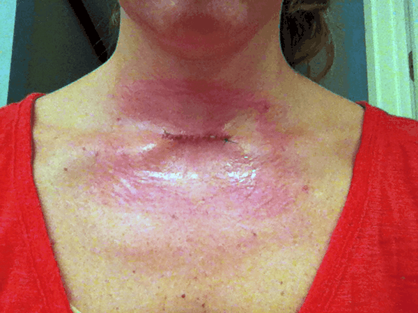 After picture of the stitches from mohs surgery on my neck