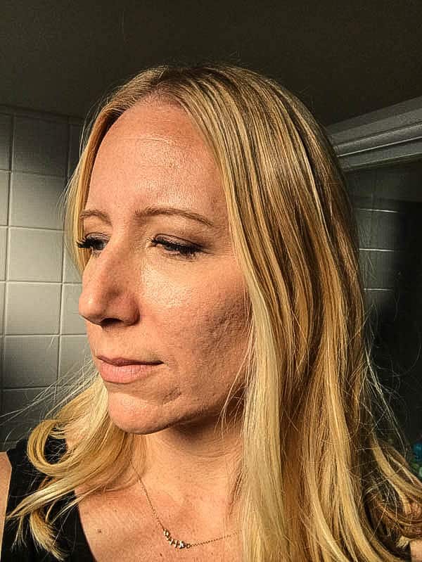 Women's face showing her acne scarred skin before a microneedling treatment.