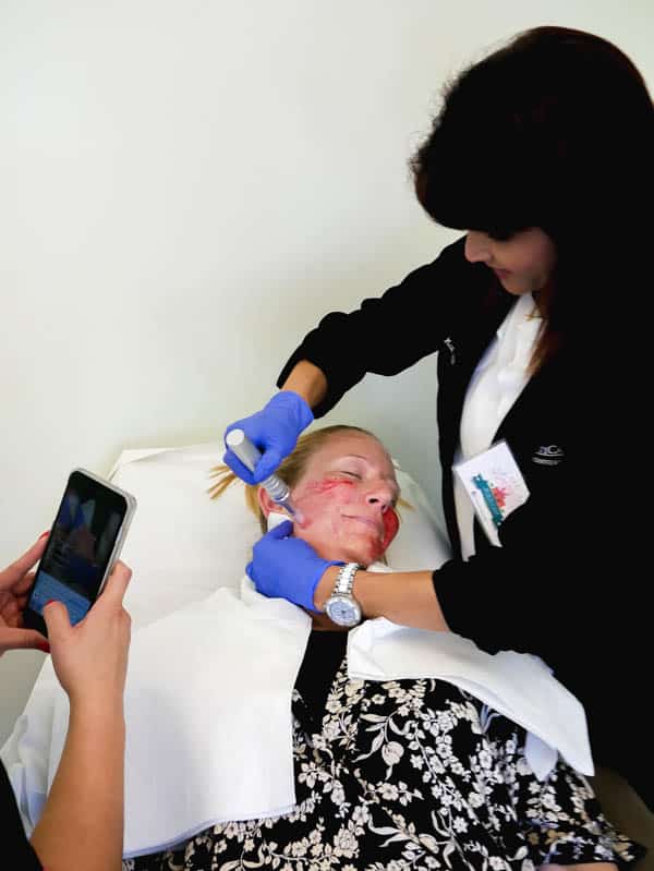 Girl laying on a treatment bed getting a microneedling treatment for acne scars.