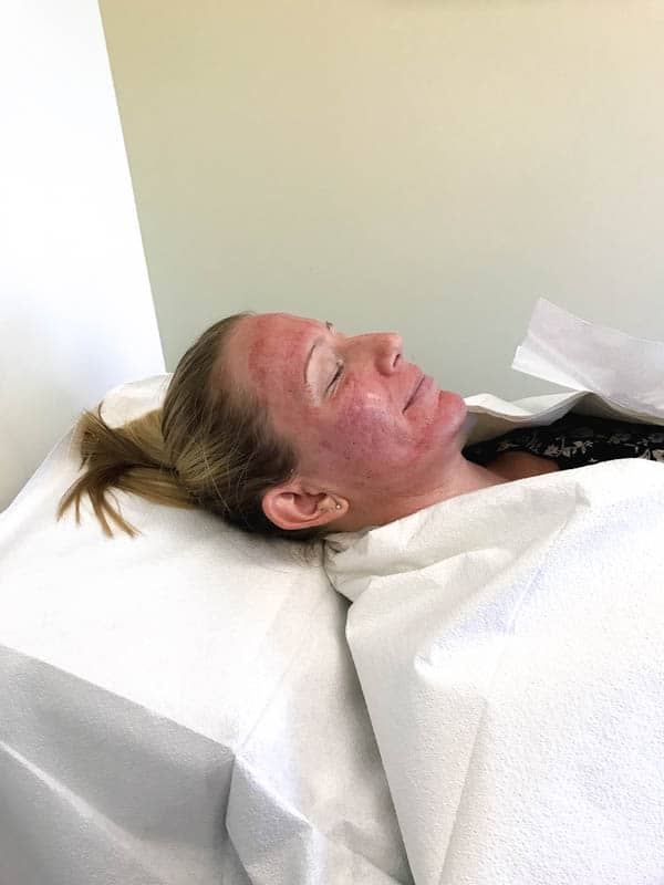 Woman's face immedaitely following microneedling acne facial treatment for scarring.