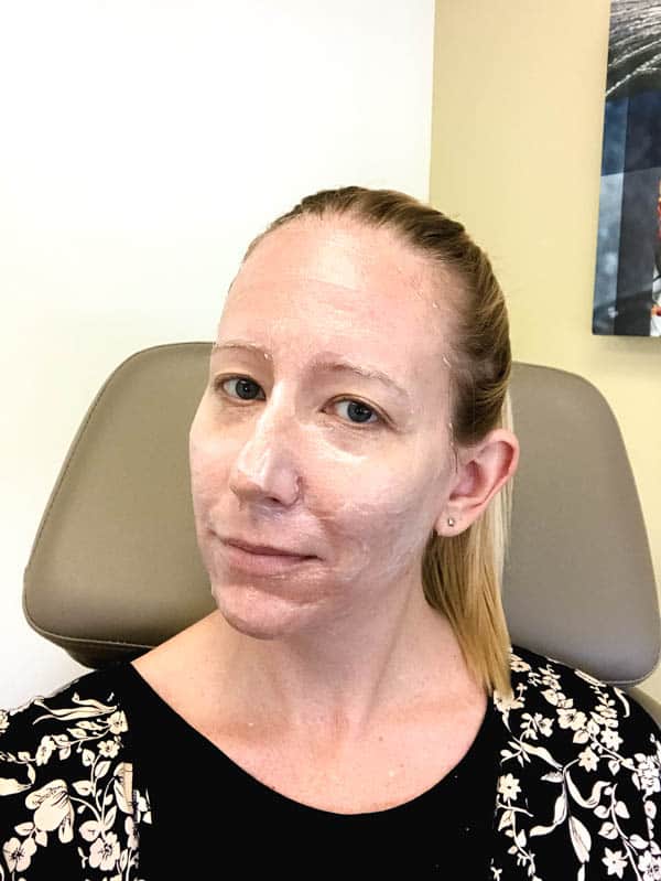 Woman with numbing cream on her face before microneedling treatment at Cosmeticare