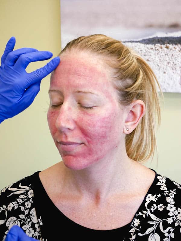 Woman with red face immediately after Microneedling facial treatment with PRP.