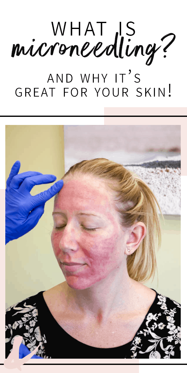woman with red face as a result of microneedling with PRP with text on it