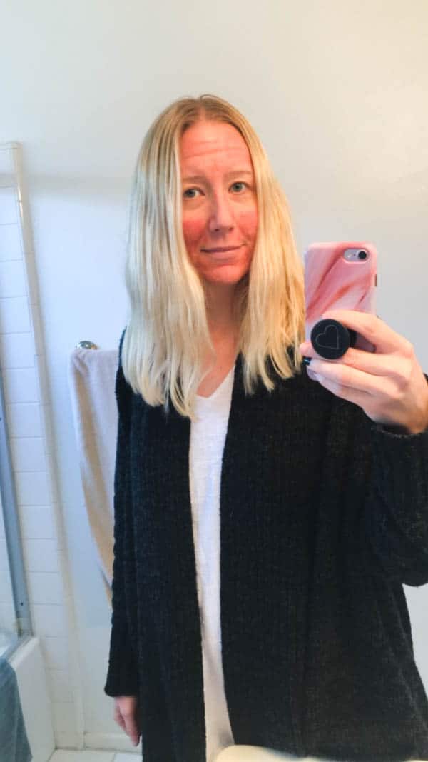 Woman taking a photo of herself in a mirror with a red face after a microneedling treatment.