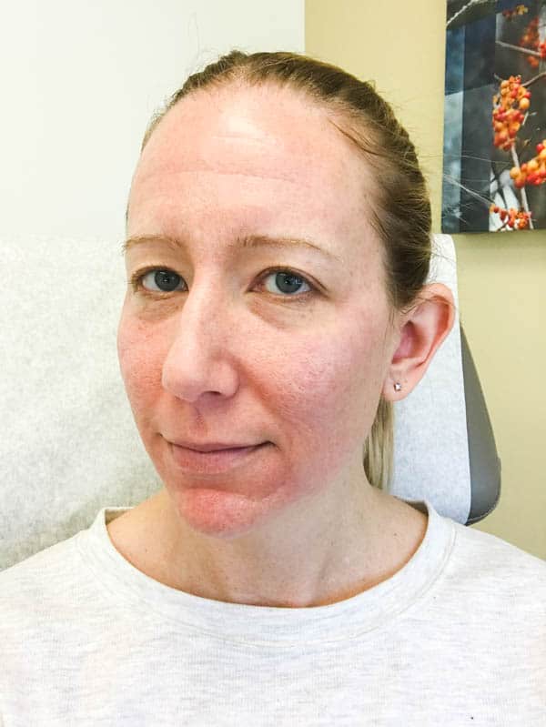 Close up of a woman's face before having a microneedling treatment at for acne scar removal. 