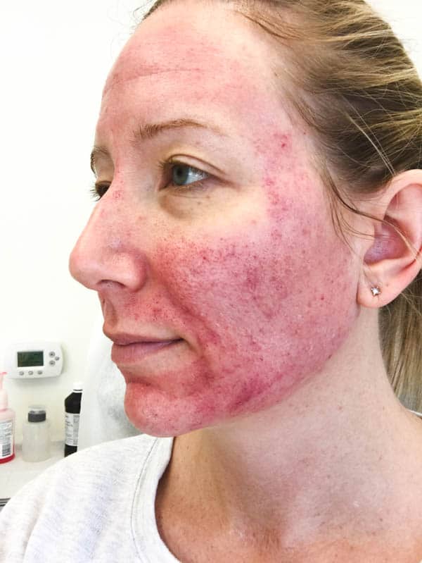 Close up of a woman's face who has just had microneedling to reduce acne scars.