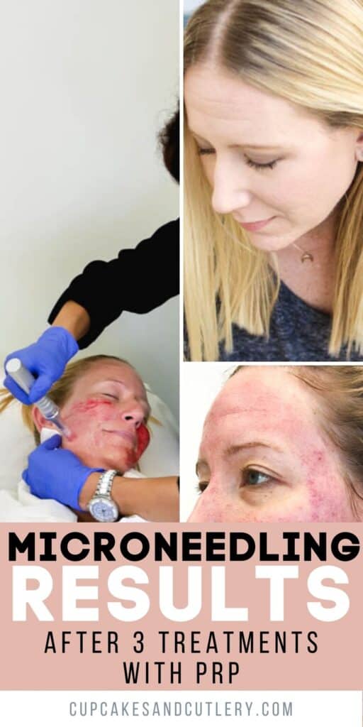 Collage of images about microneedling with text over it.