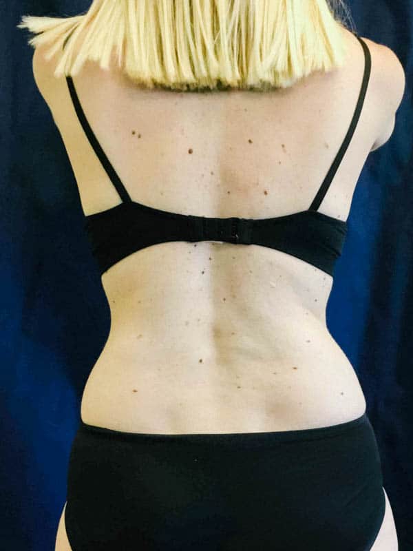 Photo from behind to show flanks before Coolsculpting.