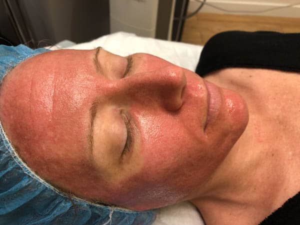 Close up of a woman's face after getting CO laser skin resurfacing in Orange County. 