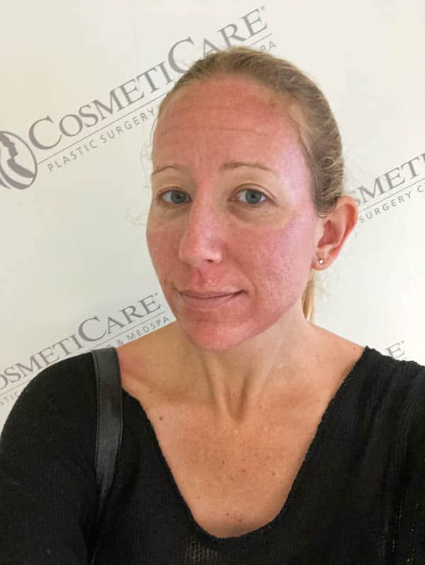 A woman's face after laser resurfacing treatment to show what your face looks like after the procedure. 