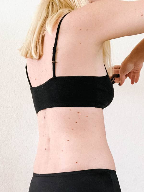 After photo of a side view from my Coolsculpting on my flanks.