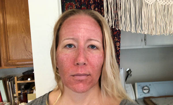 After photo of a a woman's face after having a co2 laser facial.