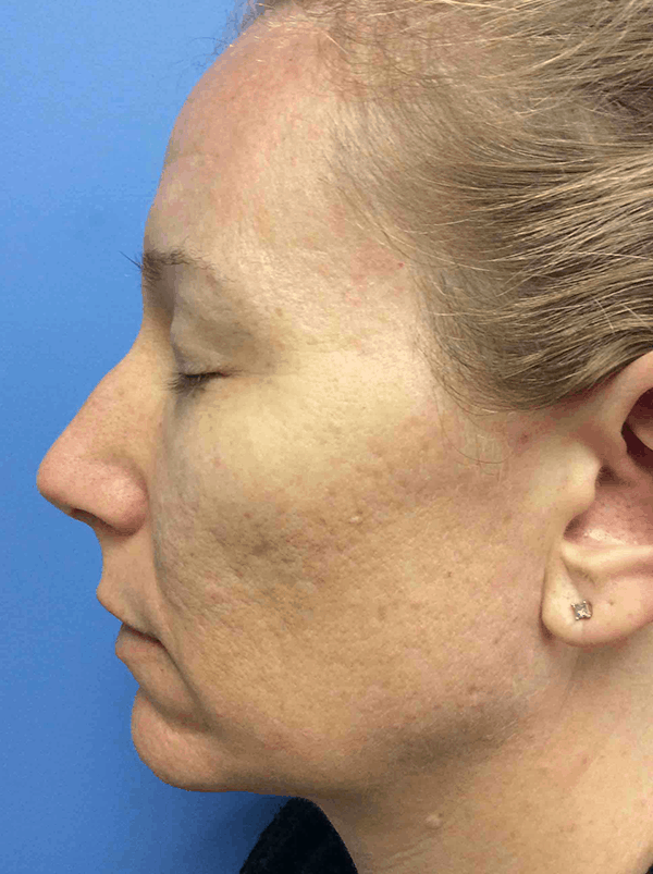 Before photo of my co2 laser skin resurfacing treatment