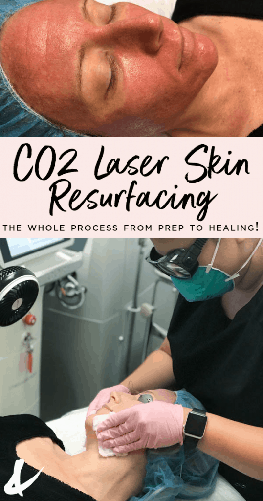 co2 laser skin resurfacing from prep to healing