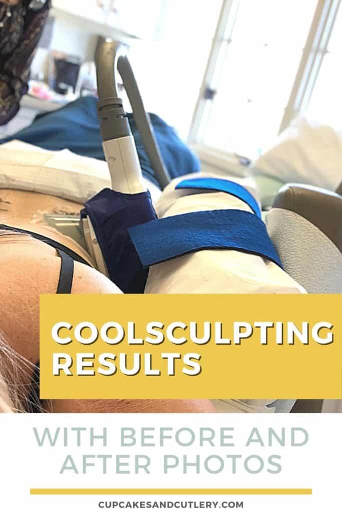 Woman laying on her stomach and getting Coolsculpting done on her flanks.