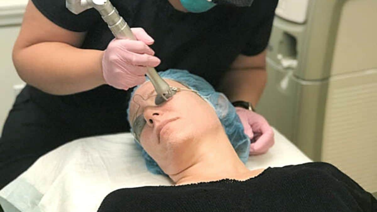 CO2 Laser Skin Resurfacing Treatment and Recovery (Before and After