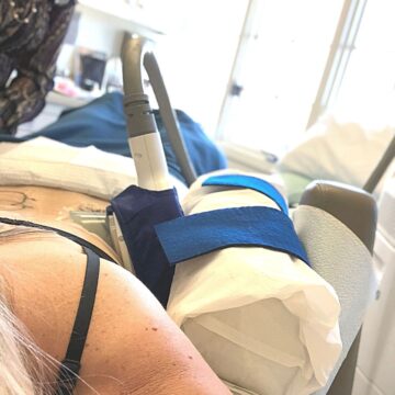 Close up of woman having a Coolsculpting procedure on her flanks.