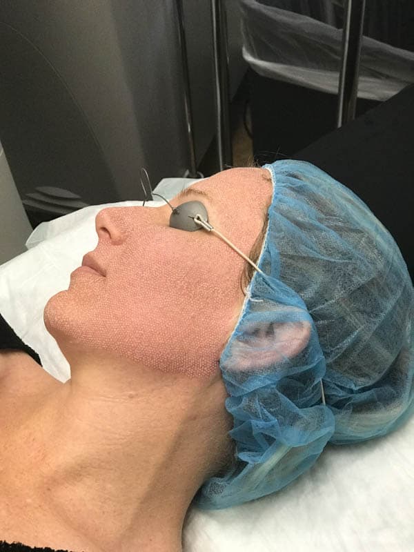 CO2 laser treatment for acne scars at CosmetiCare in Newport Beach