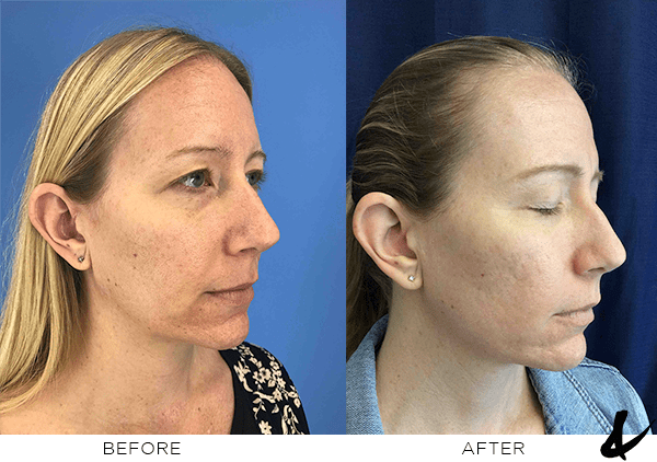 Before and after photo of laser for acne scars final results front of face