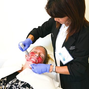 Woman getting microneedling on her face.