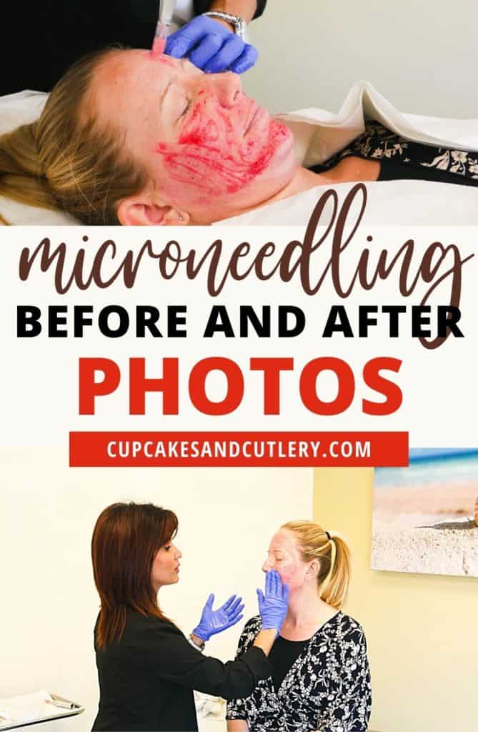 Photos of a woman having microneedling done on her face and right after the treatment with text in the middle.