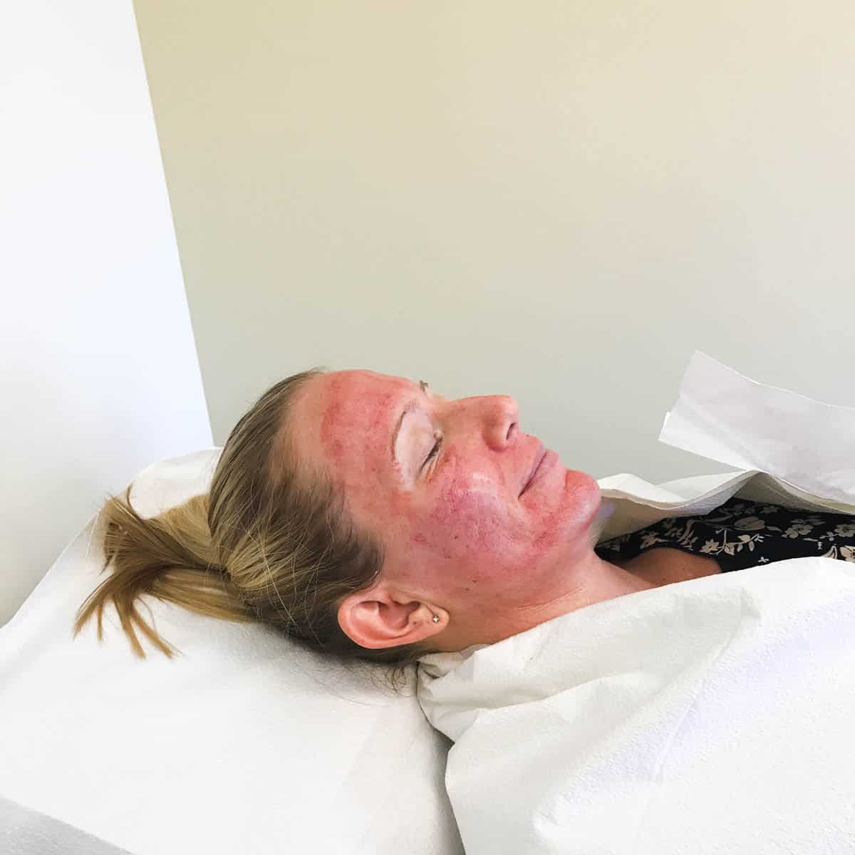 Microneedling Facial Treatment with PRP Before and After