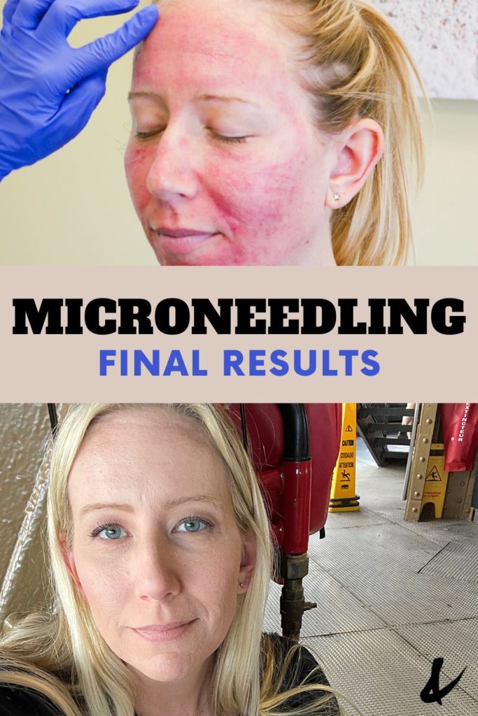 A before and after photo with text that says "microneedling final results".